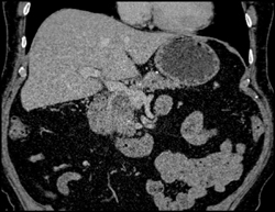 1.5 Cm Cancer of the Pancreas - CTisus CT Scan