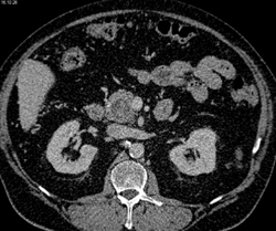 Subtle Intraductal Papillary Mucinous Neoplasm (IPMN) in Head of Pancreas - CTisus CT Scan