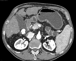 Multiple Intraductal Papillary Mucinous Neoplasms (IPMNs) - CTisus CT Scan