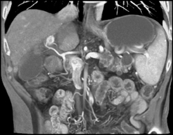 Multiple Intraductal Papillary Mucinous Neoplasms (IPMNs) - CTisus CT Scan