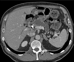 Dilated Pancreatic Duct Due to Central Intraductal Papillary Mucinous Neoplasm (IPMN) - CTisus CT Scan