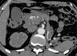 Aneurysms Off Hepatic Artery - CTisus CT Scan