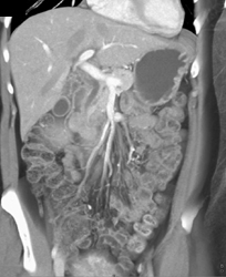 Encased Superior Mesenteric Vein (SMV) Due to Pancreatic Cancer - CTisus CT Scan