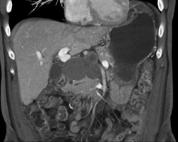 Cystadenoma - CTisus CT Scan