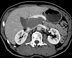 Cystadenoma - CTisus CT Scan