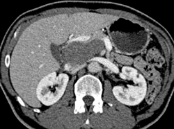 Cystadenoma - CTisus CT Scan