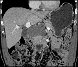 Cystadenoma - CTisus CT Scan