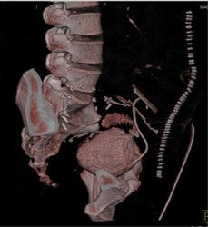 Pancreatic Transplant With Duct Attached to Bladder Dome - CTisus CT Scan