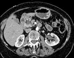 Intraductal Papillary Mucinous Neoplasm (IPMN) - CTisus CT Scan