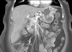 Intraductal Papillary Mucinous Neoplasm (IPMN) - CTisus CT Scan