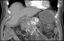 Islet Cell Tumor - CTisus CT Scan