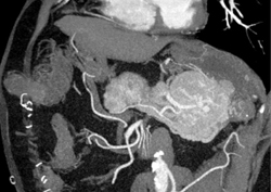 Islet Cell Tumor - CTisus CT Scan