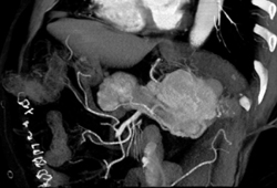 Islet Cell Tumor - CTisus CT Scan