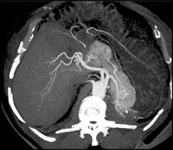 Islet Cell Tumor - CTisus CT Scan