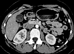 Islet Cell Tumor - CTisus CT Scan