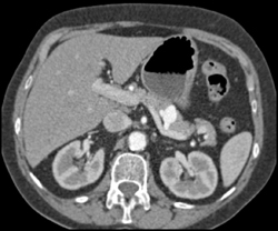 Splenic Artery Aneurysm Simulates An Insulinoma - CTisus CT Scan