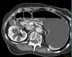 Dilated Pancreatic Duct Due to Pancreatic Cancer - CTisus CT Scan