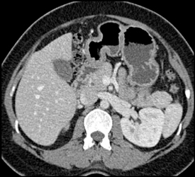 Islet Cell Tumor in Tail of Pancreas-insulinoma - CTisus CT Scan