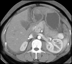 Insulinoma - CTisus CT Scan