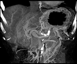 Pancreatic Cancer Encases PV/SMV With Collaterals - CTisus CT Scan