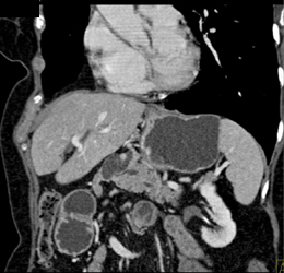 Intraductal Papillary Mucinous Neoplasm (IPMN) - CTisus CT Scan