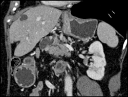 Intraductal Papillary Mucinous Neoplasm (IPMN) - CTisus CT Scan