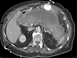 Pancreatic Abscess and Hemorrhage - CTisus CT Scan