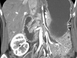 Mildly Dilated Common Bile Duct (CBD) With Nice Duodenum - CTisus CT Scan