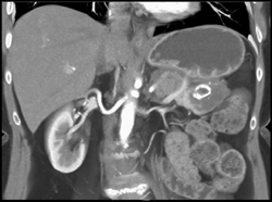 Islet Cell Tumor - CTisus CT Scan