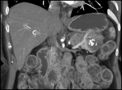 Islet Cell Tumor - CTisus CT Scan