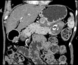 Islet Cell Tumor - CTisus CT Scan