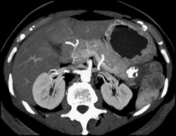 Islet Cell Tumor - CTisus CT Scan