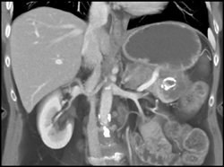 Islet Cell Tumor - CTisus CT Scan