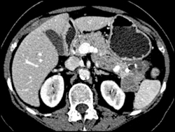 Islet Cell Tumor - CTisus CT Scan