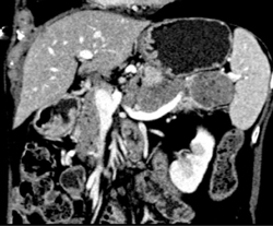 Islet Cell Tumor - CTisus CT Scan