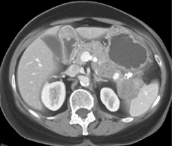 Islet Cell Tumor - CTisus CT Scan