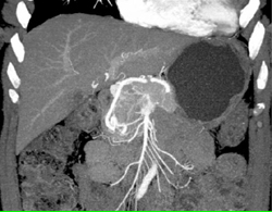 Islet Cell Tumor - CTisus CT Scan