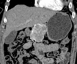 Islet Cell Tumor - CTisus CT Scan