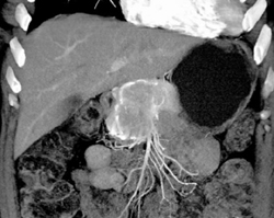 Islet Cell Tumor - CTisus CT Scan