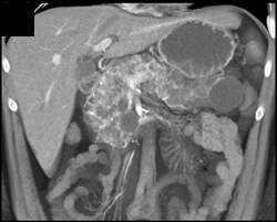 Von Hippel Lindau With Pancreatic Cysts - CTisus CT Scan