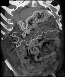 PV/SMV Encasement With Collaterals - CTisus CT Scan