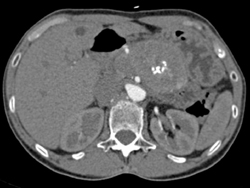 Islet Cell Tumor - CTisus CT Scan