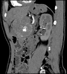 Islet Cell Tumor - CTisus CT Scan