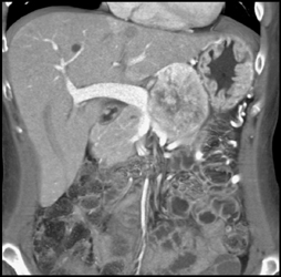 Islet Cell Tumor - CTisus CT Scan