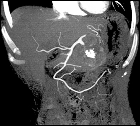 Islet Cell Tumor - CTisus CT Scan