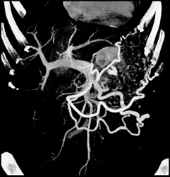 Islet Cell Tumor - CTisus CT Scan