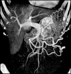 Tumor Encases and Occludes Splenic Vein - CTisus CT Scan