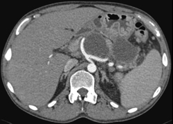 Pancreatic Pseudocysts With Splenic Vein Occlusion - CTisus CT Scan