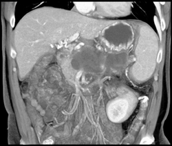 Pseudocysts With Cavernous Transformation of the Portal Vein (CTPV) With Splenic Vein Occlusion and Collaterals - CTisus CT Scan