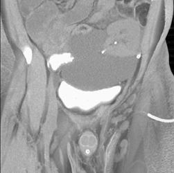 Pancreatic and Renal Transplants - CTisus CT Scan